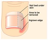 Ingrown toe nail surgery